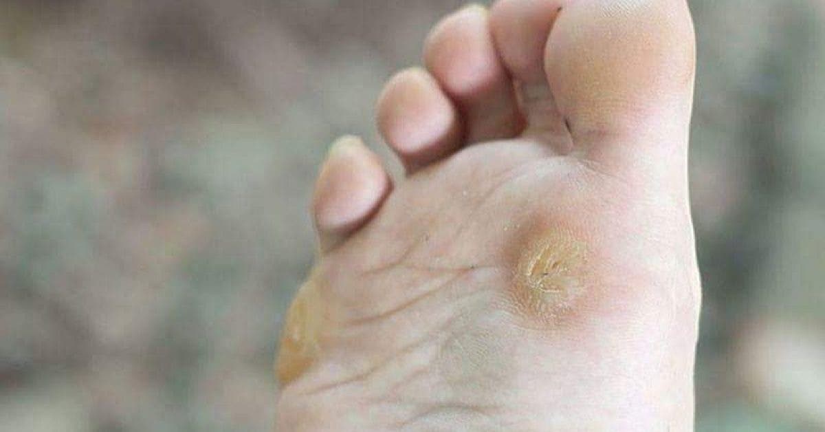 24 Pansements Pour Cors Aux Pieds – Traitement Des Verrues Plantaires Et Callosités, Neufs