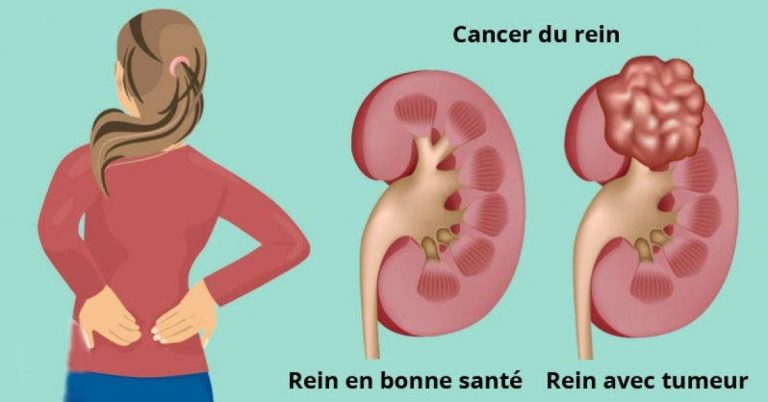 Globules Rouges Et Rein 7 symptômes du cancer du rein auxquels il faut faire attention