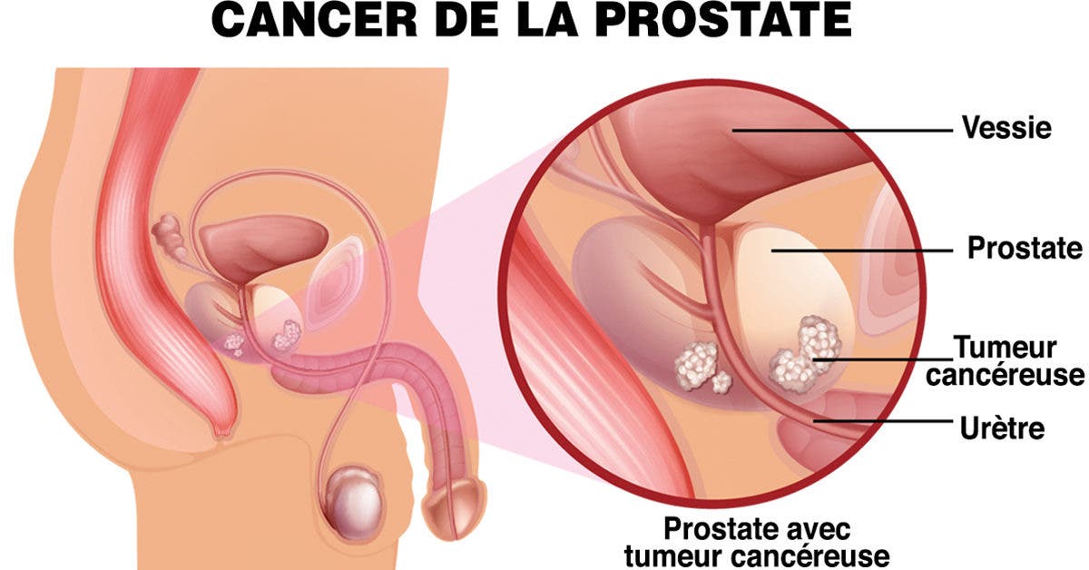 12 Symptômes Du Cancer De La Prostate Auxquels Il Faut Faire Attention 0891