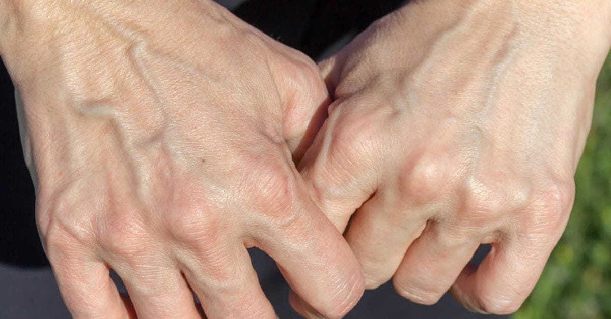 Pourquoi certaines personnes ontelles les veines apparentes